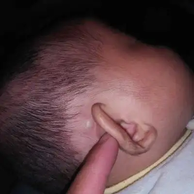 婴儿耳朵边上长了个白色的汽泡是什麼