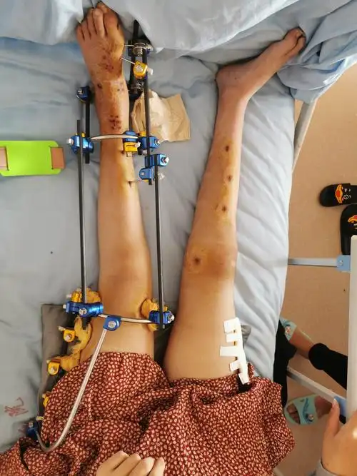 术后第77天(2020.3.10)