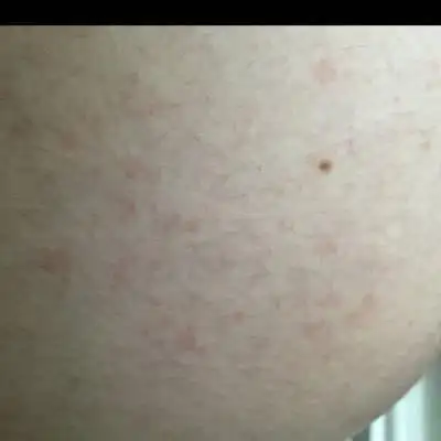 26周,肚子上怎麼这麼多红点,不痛不痒没感觉,啥情况啊,我一直在用