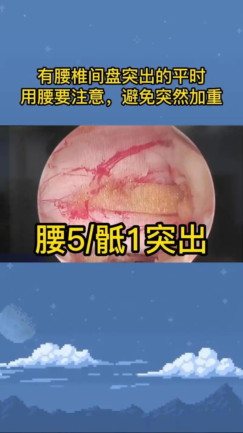 腰5/骶1椎间盘突出.腰椎间盘突出的患者,无论是保守治疗还是 - 抖音