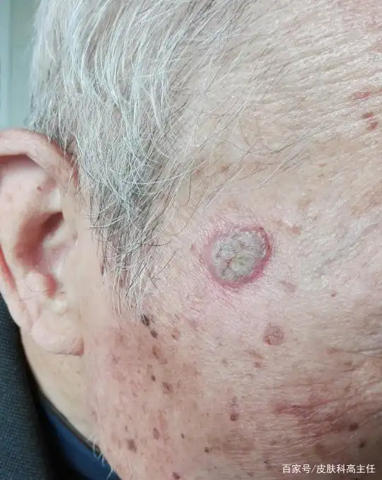 面部扁平疣需不需要治疗?