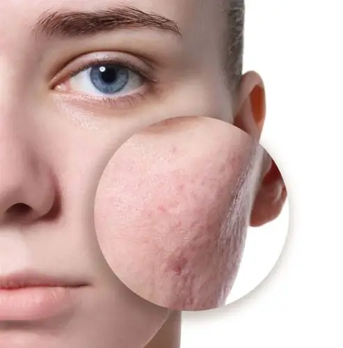 油性皮肤到中午就特别容易脱妆,而且毛孔很容易被皮肤的皮脂给堵住,久