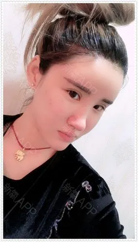 自体脂肪填充全脸,术后一个月脂肪移植效果,是不是很想看看我最近恢复