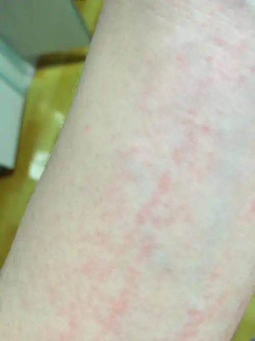 李医生您好,我开始是皮肤瘙痒,胳膊上起大面积的红色点,好像是