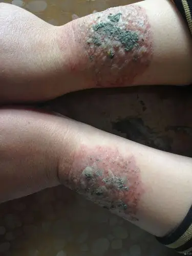 典型病例------接触性皮炎 - 皮肤及性传播疾病讨论版 - 爱爱医医学