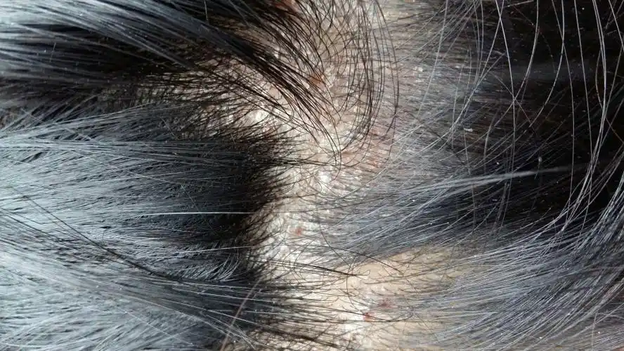 头皮成这样了,这是什么症状?