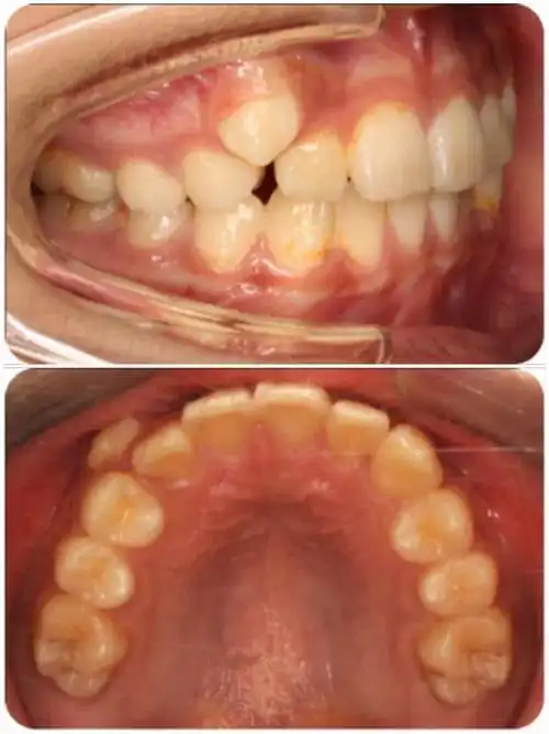 尖牙vs虎牙 这次我pick这颗长得壮又能吃的牙_儿童牙病_疾病介绍_相关