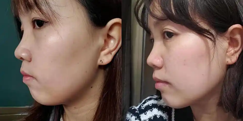 戴牙套11个月,看我这个效果怎么样?目前还在矫正中