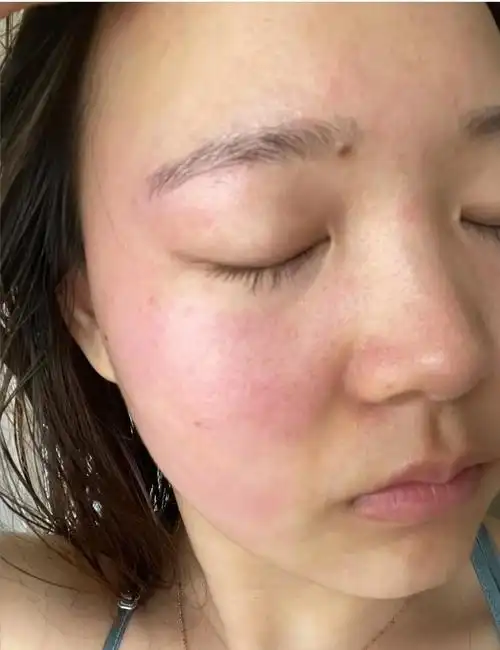 如何改善脸上皮肤特别薄,一直泛红,毛孔粗大,红血丝明显?