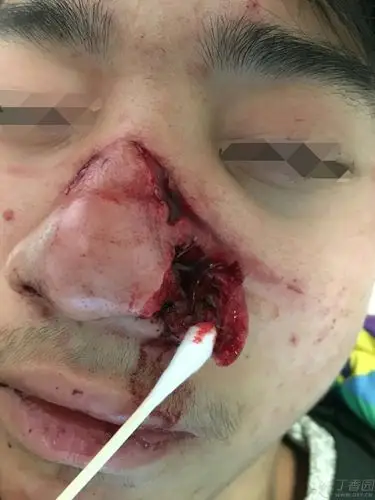 【讨论】分享一例鼻部外伤清创