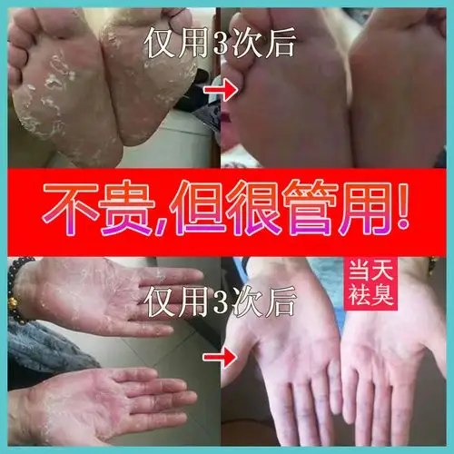 云南草本脚跟龟裂脚后跟干裂蜂蜡手足愈裂皲防裂冻裂疮膏手脚开裂