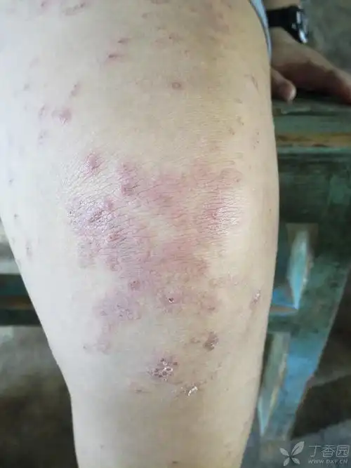 皮肤与性传播疾病讨论版