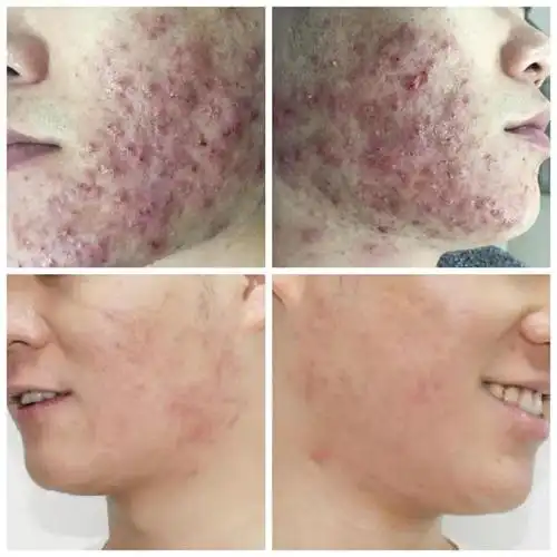 写美篇没有痘痘的你,笑起来还是蛮帅的!