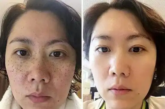 睡前这样做祛斑养颜四十岁不显老