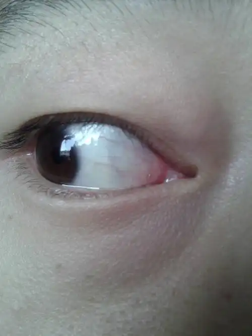 眼睛红血丝怎么办?而且还略带黄色.