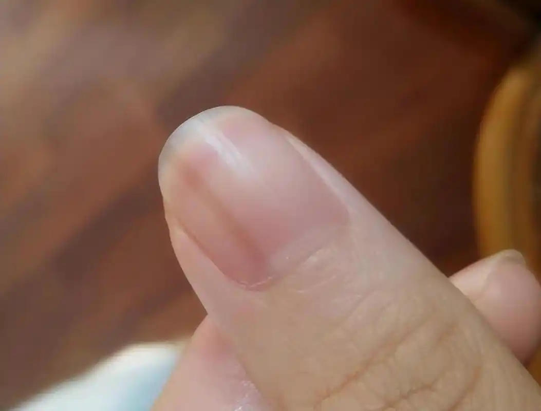 指甲上有竖纹,究竟是咋回事?是老人说的肝不好吗?
