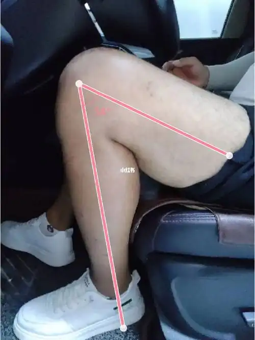 髌骨骨折100天,被动角度才120,愁