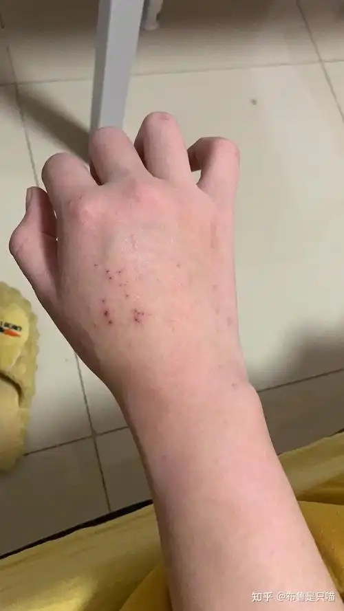 乙肝长效干扰素记录及副作用(首次77针)2次干扰素治疗中  结束啦