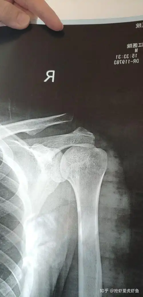 肩锁关节脱位手术治疗及康复第一周