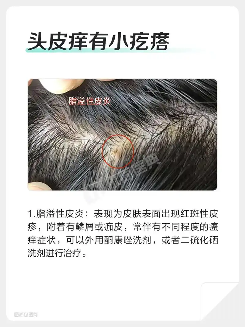 头皮痒有小疙瘩怎么治疗.很多朋友们都出现过头皮问题.