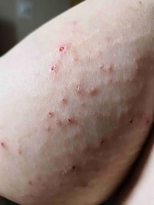 请问一下上周开始皮肤莫名的干痒,没注意,后来总是抓就这样了,是什么