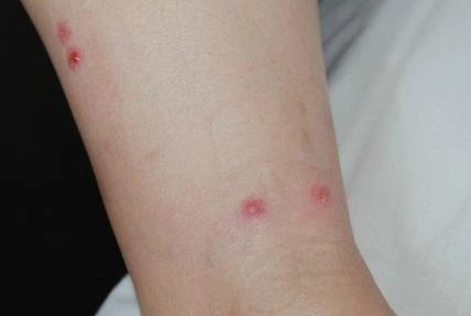 跳蚤咬的症状图片杀虫公司教你跳蚤怎么消灭