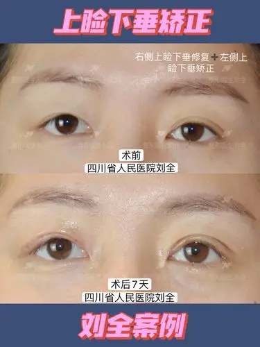 上睑下垂术后七天
