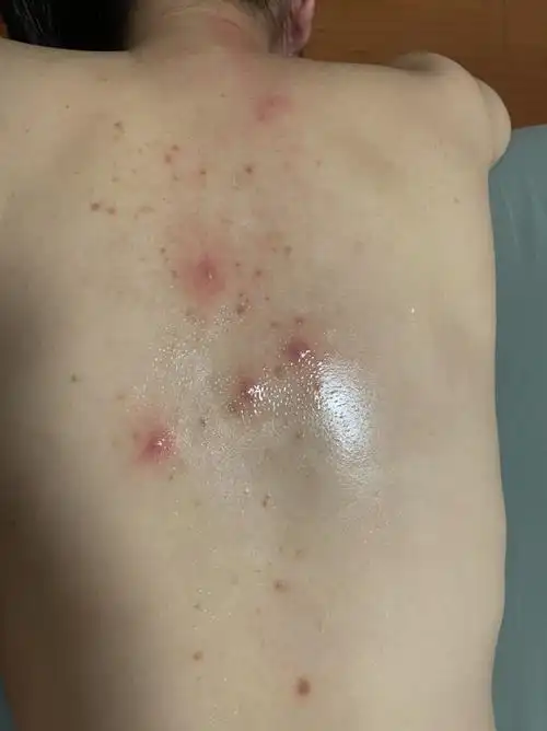 后背马拉色菌毛囊炎面部未检查