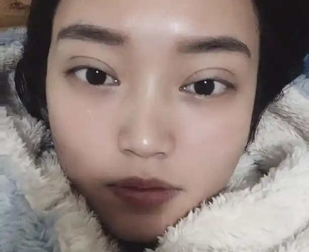 双眼皮开的太宽图