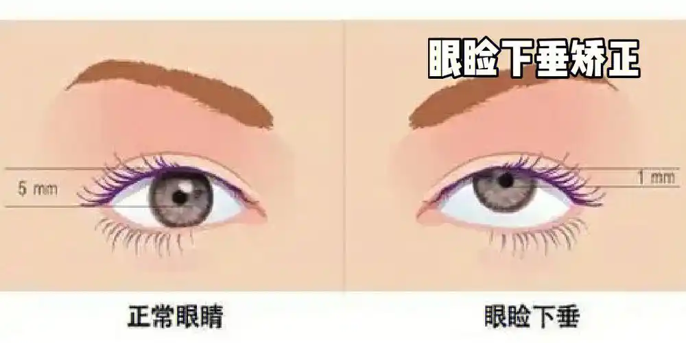 眼睑下垂矫正后需要注意什么