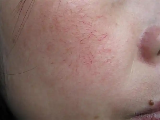 面部红血丝如何治疗? - 皮肤及性传播疾病讨论版 - 爱爱医医学论坛