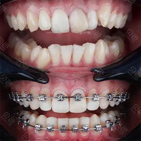 大龄女青年矫正牙齿效果,我来告诉你自锁牙套矫正效果如何!