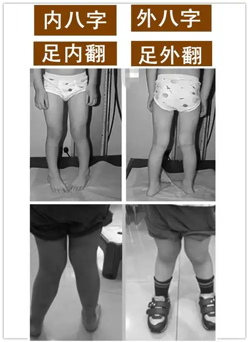 3062020年6月18日61五行小资讯说到一岁宝宝走路内八字,大家都知道
