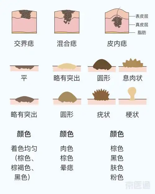 色素瘤-健康教育-清华大学附属北京清华长庚医院整形外科