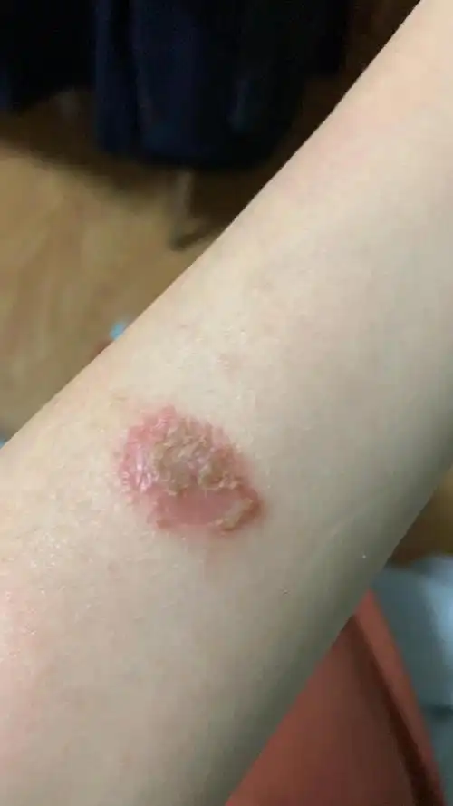 求助:湿疹一直不停感染扩散怎么办?