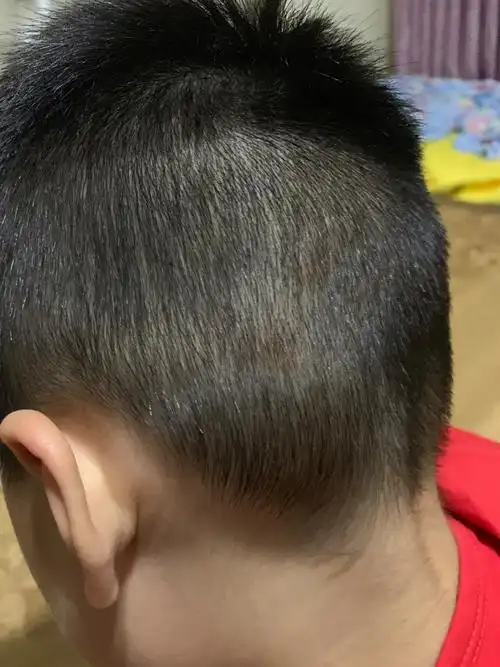 宝宝后脑勺左侧前两天有红红的有点肿起来了.没有摔去过,摸去也不疼.