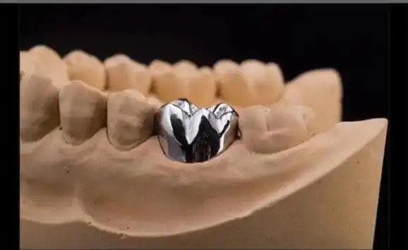 「保姆级攻略」想做种植牙:一篇文章教你找到最靠谱的种植方案!