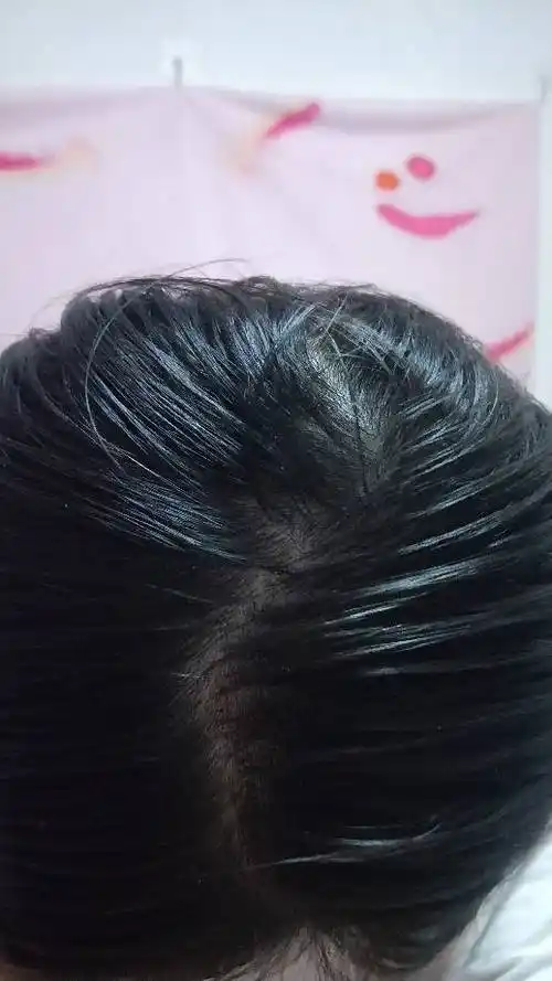 用梳子从头顶分一个 头皮就裸露了这么多.发量算正常吗?