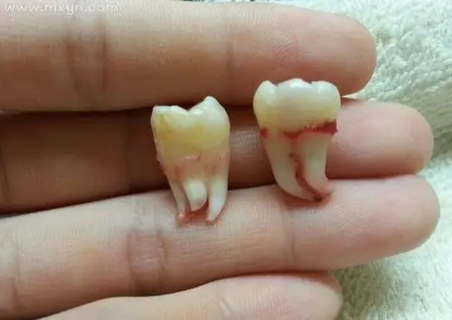 梦见牙齿松动自己拔掉
