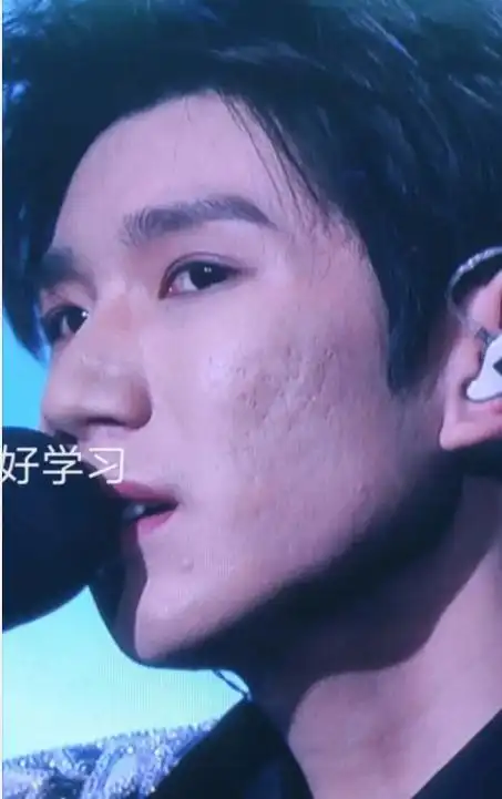 王源近照曝光,满脸痘印似大叔?小鲜肉翻车被嘲颜值下滑