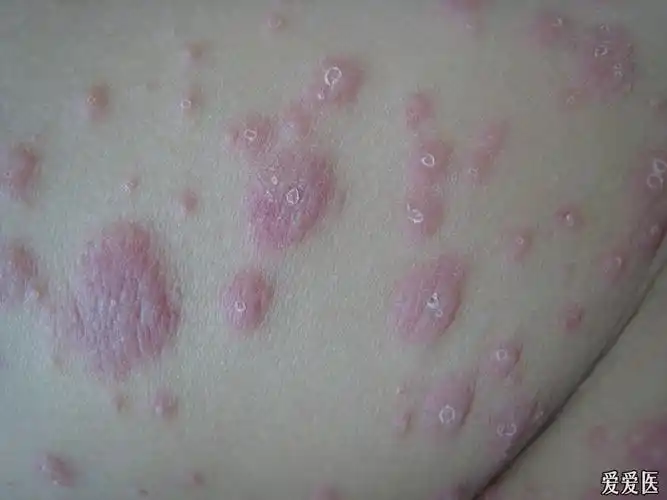 螨虫皮炎治疗前后您来看一看