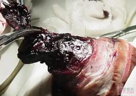 于21天前在当地妇幼保健站行包皮环切术,手术方式不详,术后发生阴茎