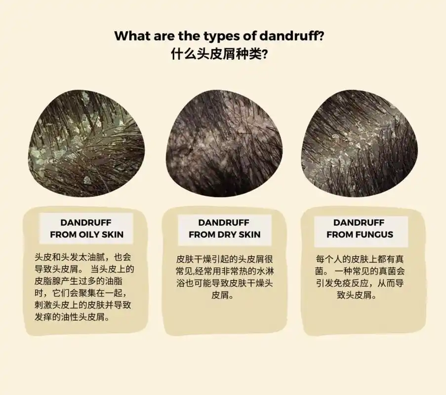 解决 油性 干性 头皮屑.how to solve your - 抖音