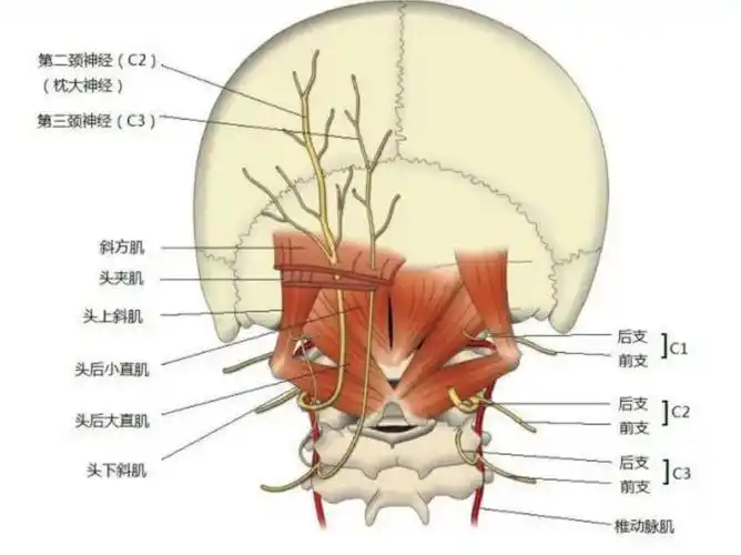 即使没有脑膜感染,也可引起头痛.