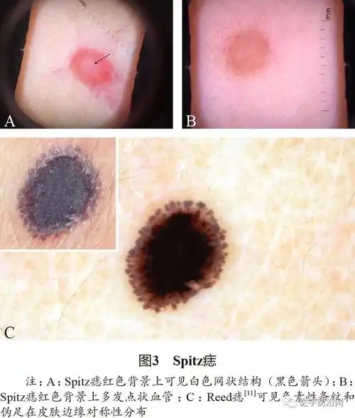 面部常见皮肤病皮肤镜诊断专家共识转载