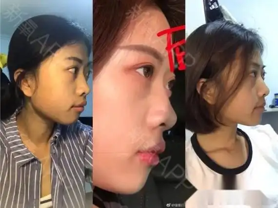 戴牙套一年三个月对比图