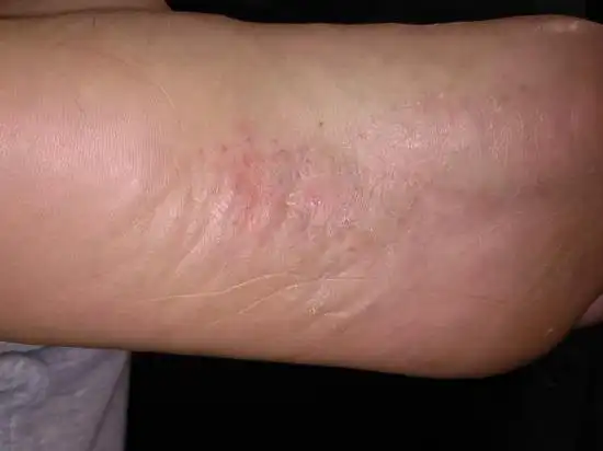 表面有蜕皮现象,之前轻微的不适感完全消失,只是还有一些红点依然清晰