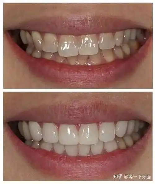 牙齿贴面 - 知乎