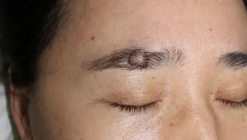 眉间色素痣切除经验分享_痣_痣治疗方式 - 好大夫在线