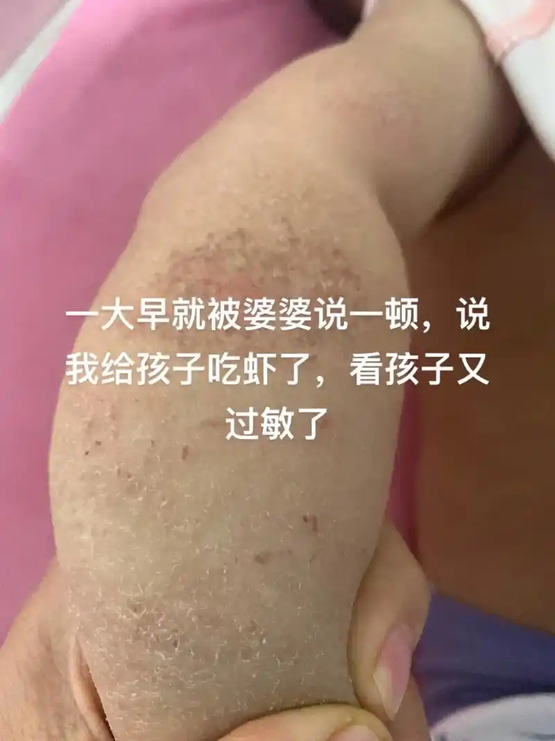 大早上就被婆婆给说一顿,说我非要给孩子吃.虾看现在过敏了,但 - 抖音